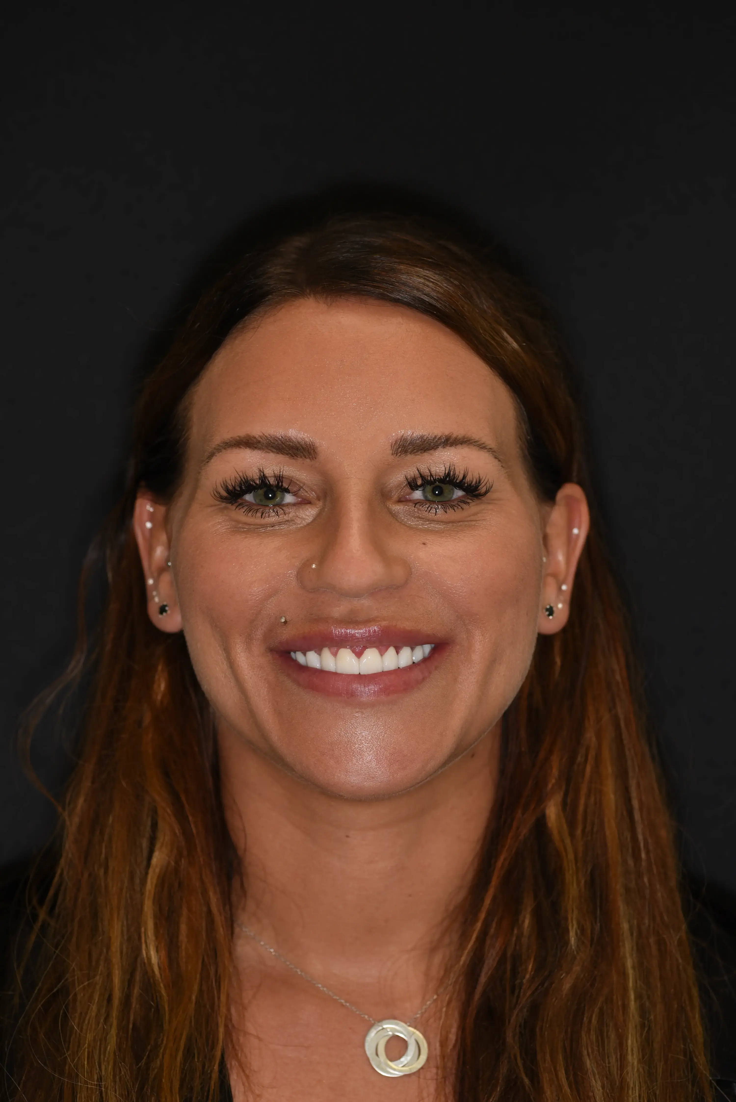 Etter - Digitalt Smile Design resultat