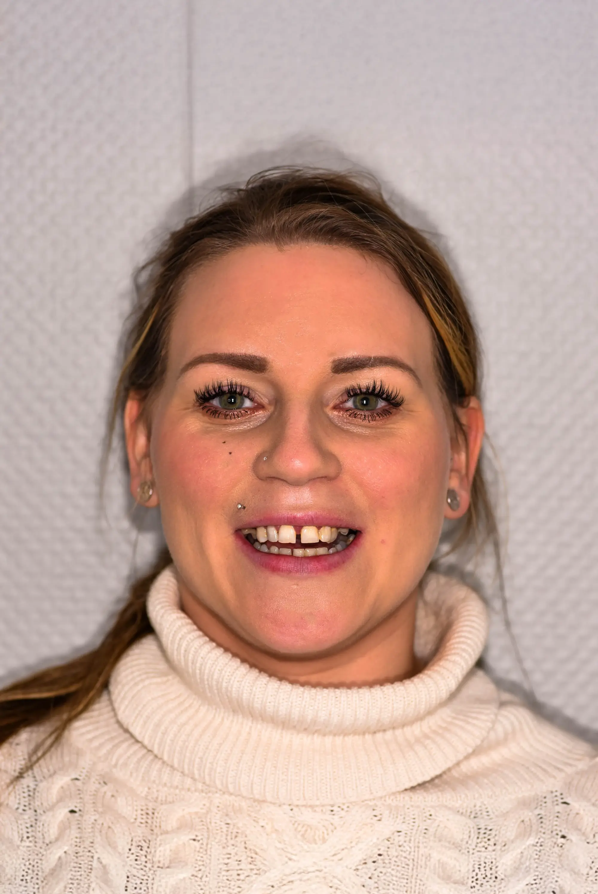 Før - Opprinnelig smil