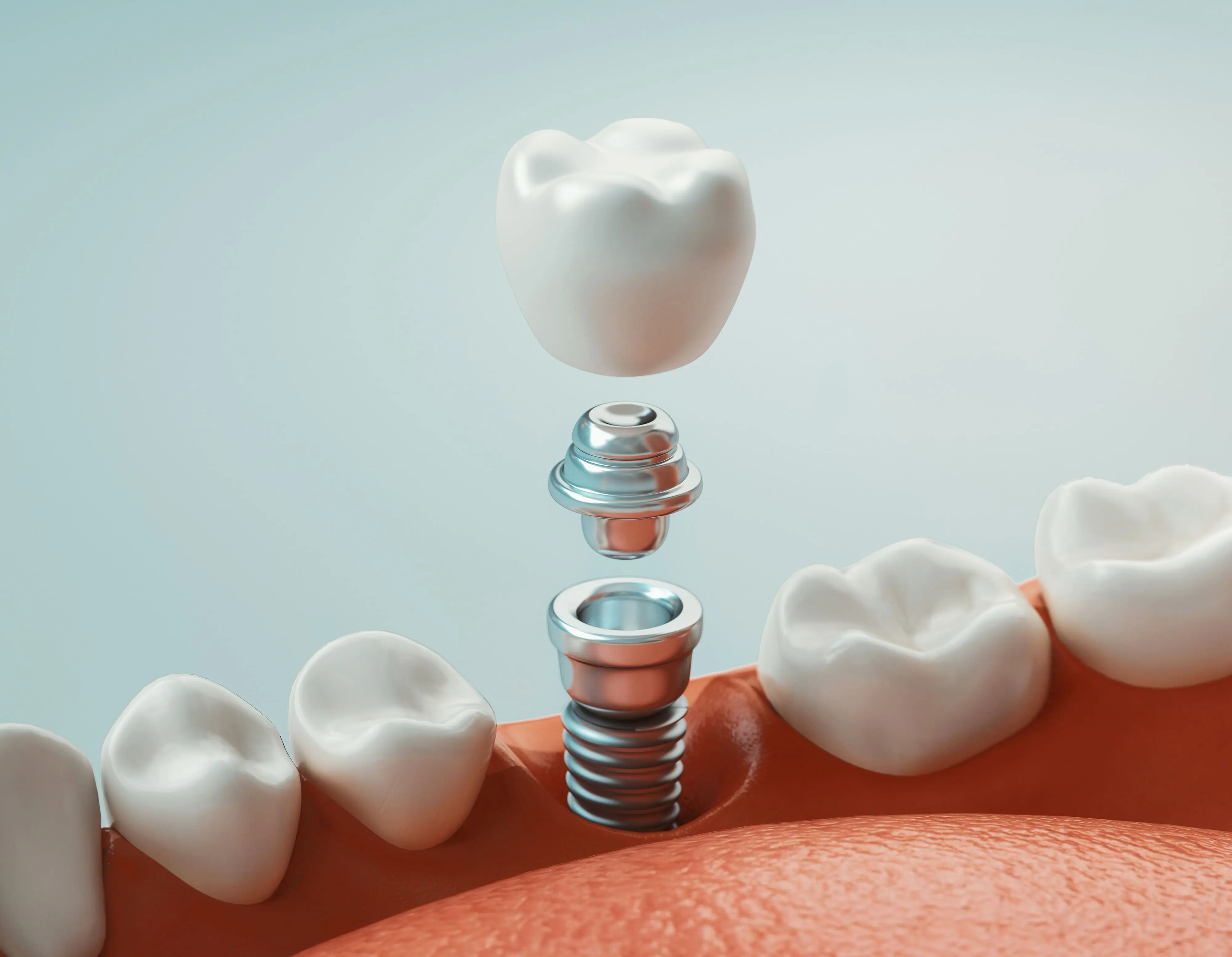 Implantat Krone